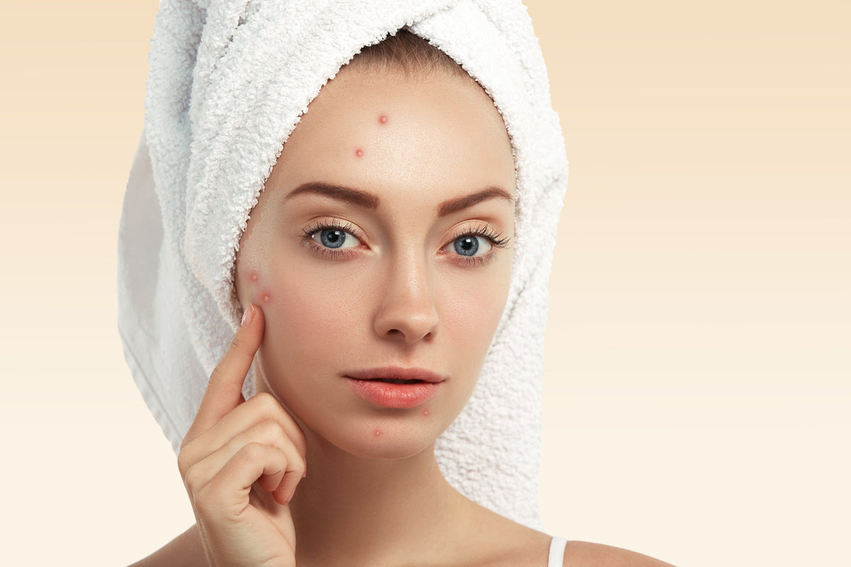 Acne on Your Jawline Again? Hormonal Imbalance Solutions and What Helps